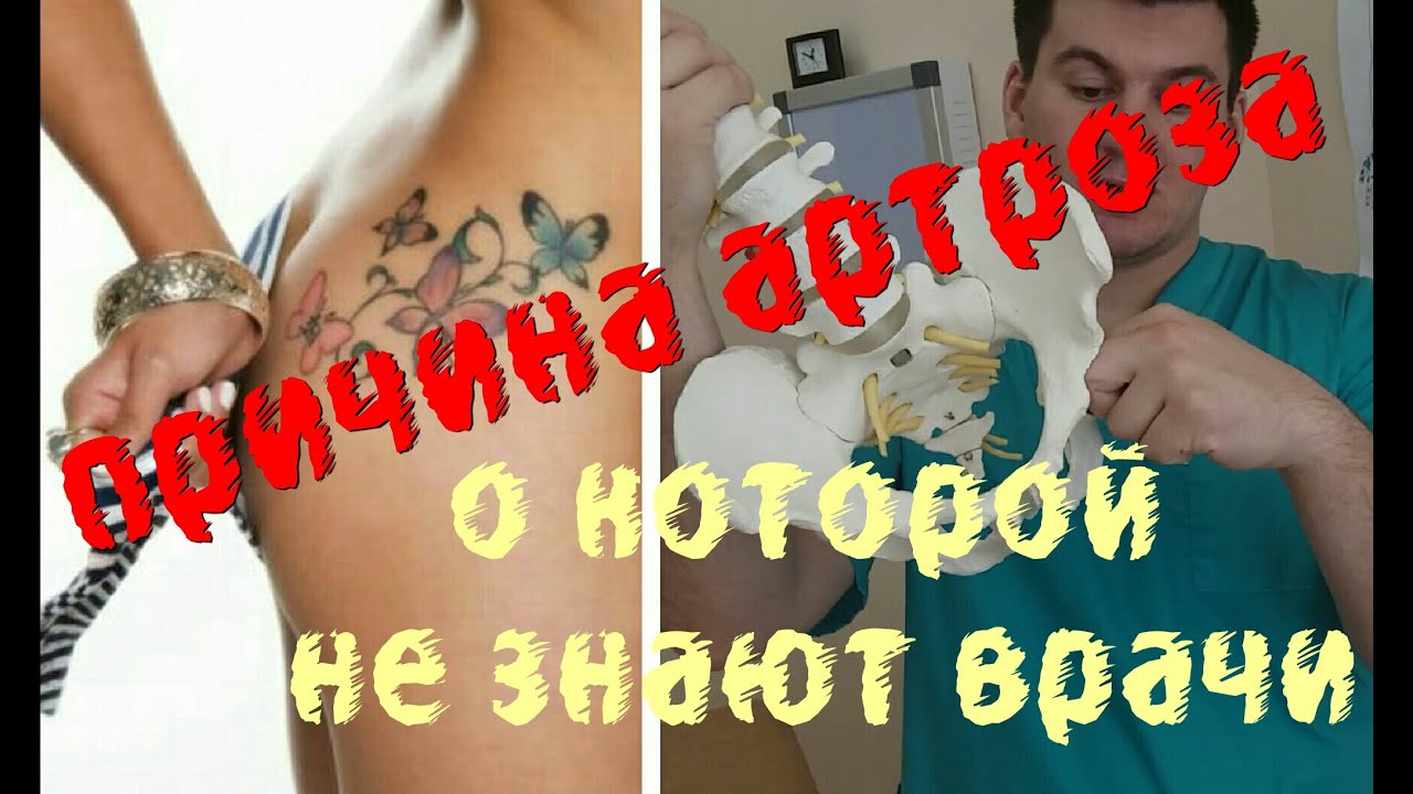 Причины артроза о которых не знают врачи.  Causes of osteoarthritis which doctors do not know